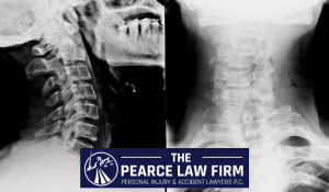 philadelphia car accident physical therapy lawyer whiplash